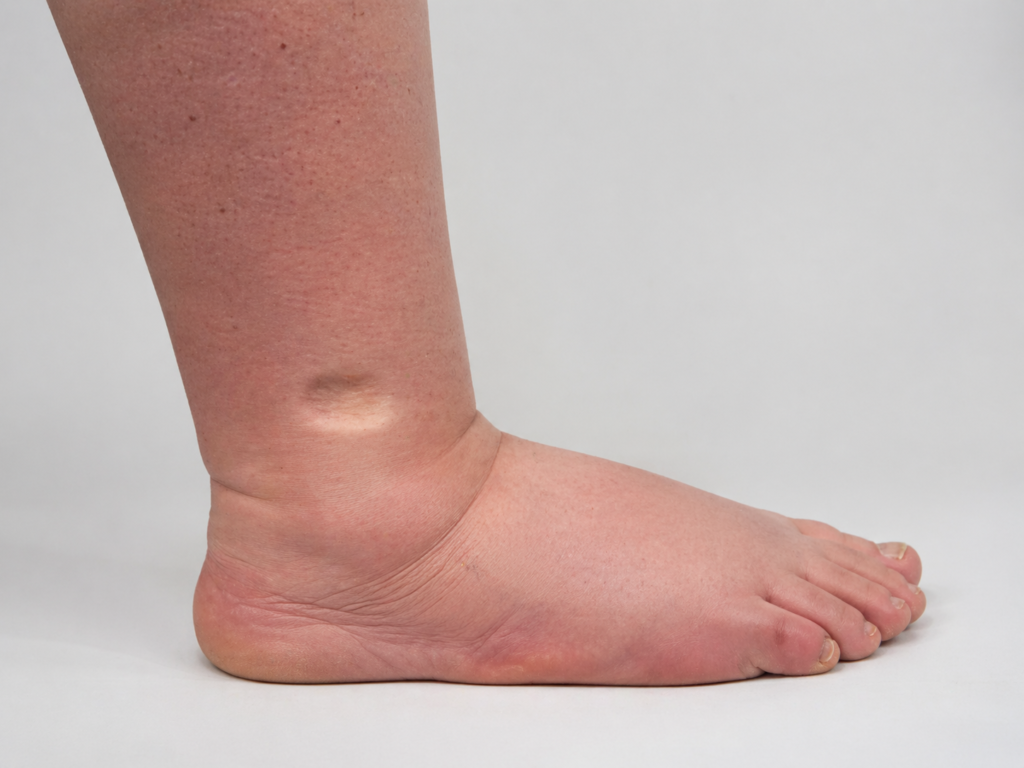 Stemmer-Zeichen Test — klinische Diagnose des Lymphödems